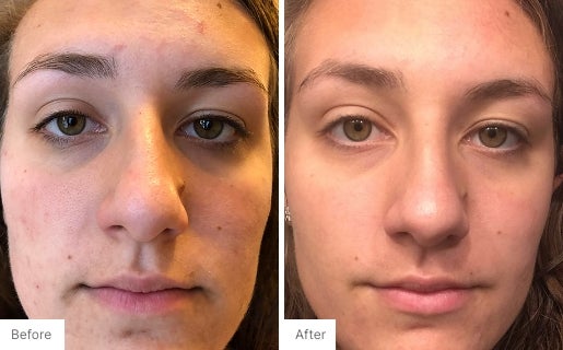 Acne Real Results Image 7